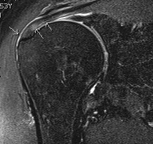 Shoulder MRI Articular Supraspinatous Tear